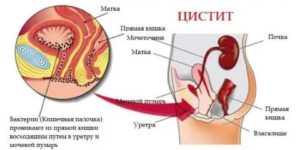 Цистит только после оргазма